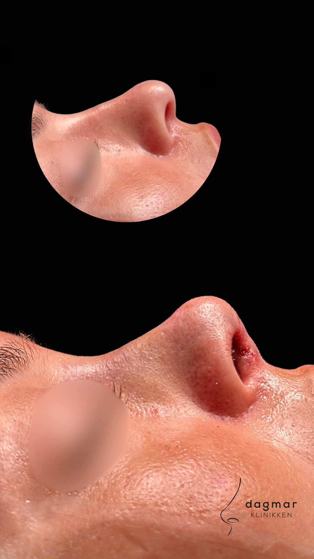 Patient 1 - Sideprofil