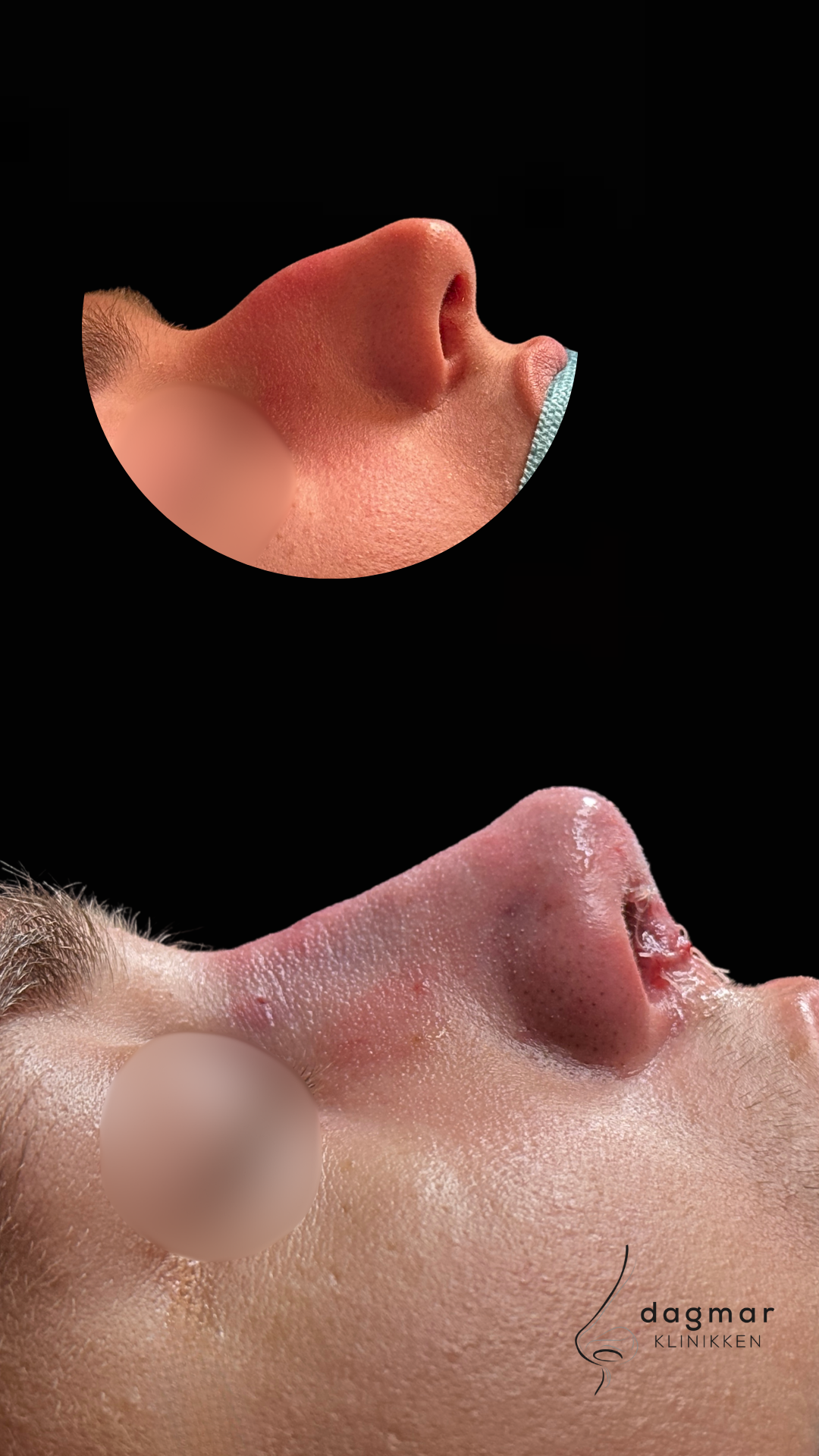 Patient 2 - Sideprofil