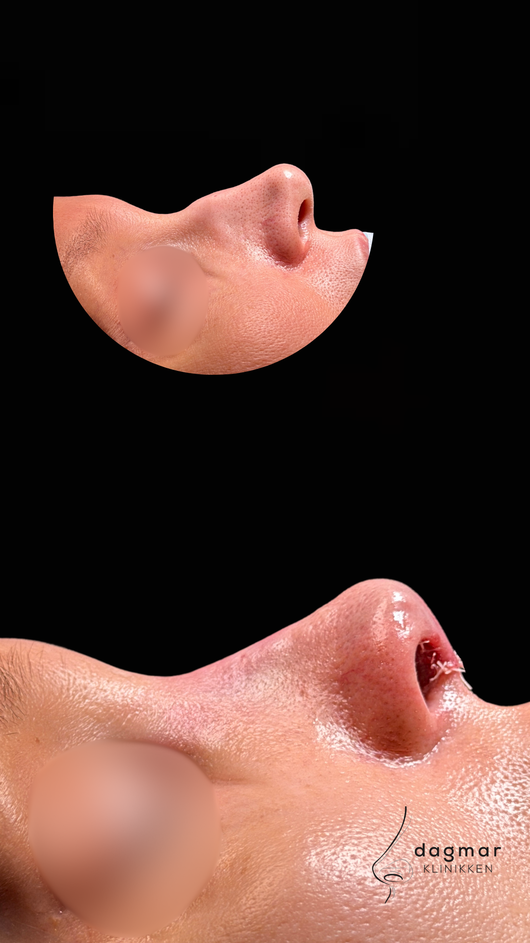 Patient 3 - Sideprofil