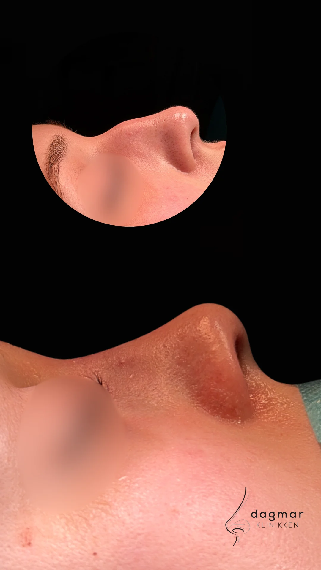 Patient 4 - Sideprofil
