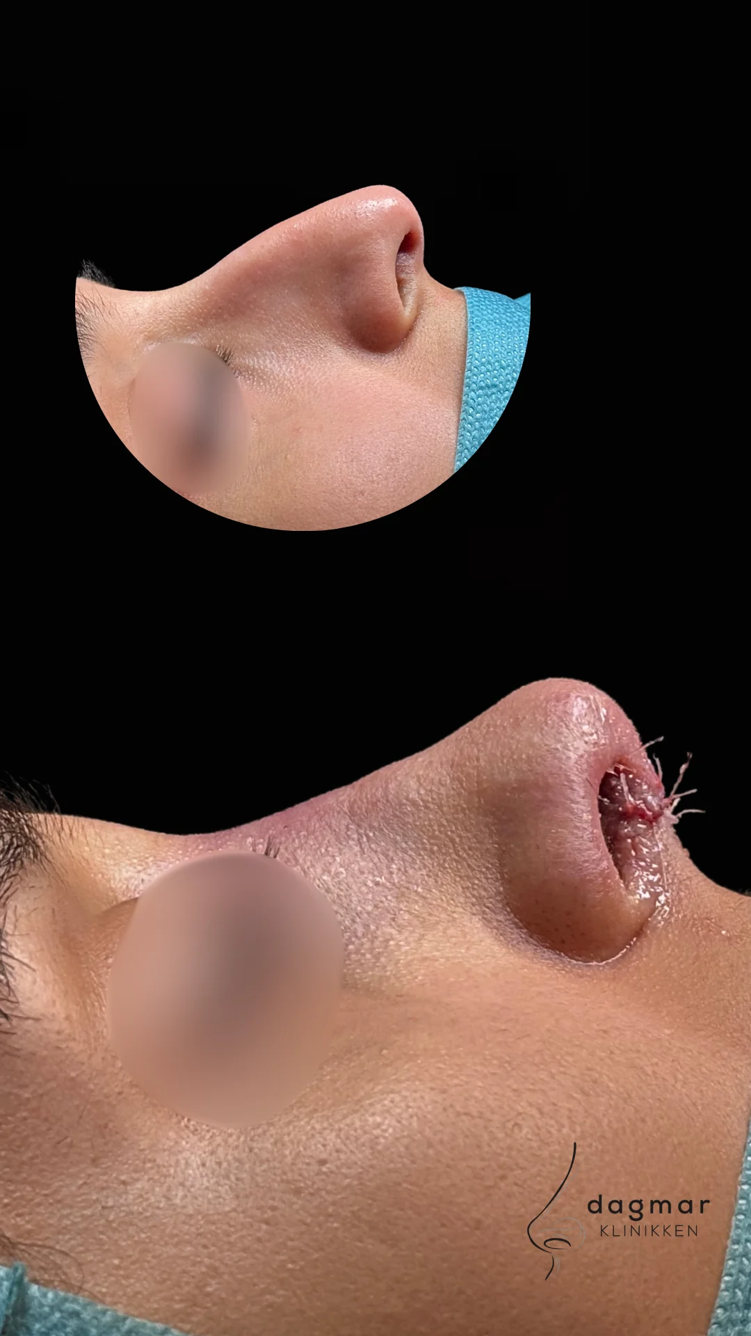 Patient 5 - Sideprofil
