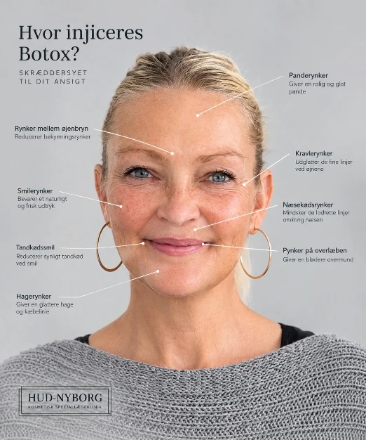 Botox Galleri - Billede 3
