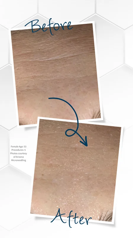 SkinPen før og efter forbedring af hudtekstur og fine linjer