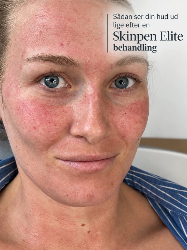 Hud umiddelbart efter SkinPen Elite behandling